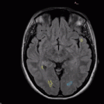 pixyl.neuro_.ms-segmentation-150x150
